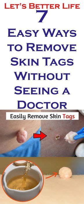 7 easy ways to remove skin tags without seeing a doctor skin tag removal skin tag oils for skin