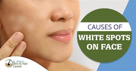 What Are Causes Of White Spots On The Face