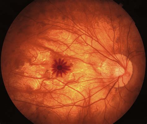 Petalloid Foveal Hemorrhage In A Patient With High Myopia