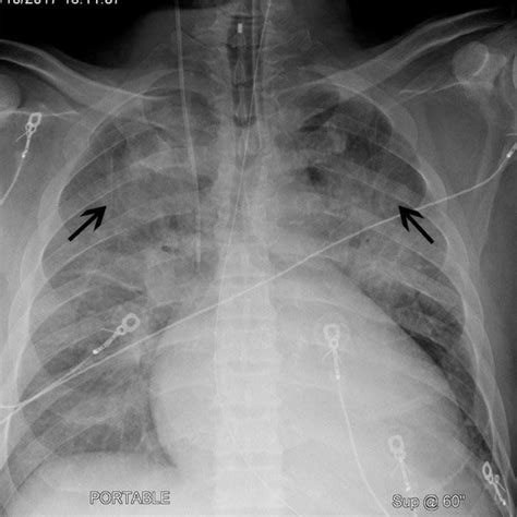 Image Chest X Ray Of A Patient With Cardiomegaly And Cephalization
