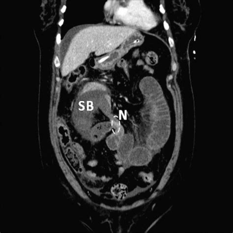 Case Of A Strangulated Right Paraduodenal Fossa Hernia In A Malrotated