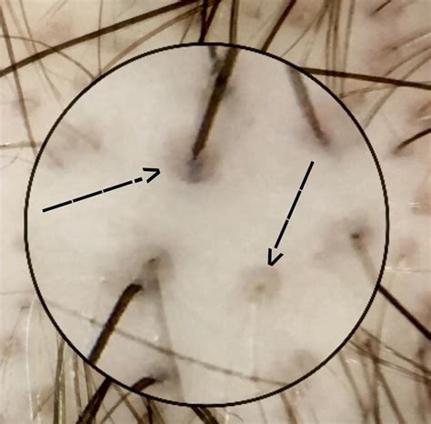 Androgenetic Alopecia The Brown Peripilar Sign — Donovan Hair Clinic