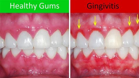 What Is Gingivitis Keridam Dental Clinic
