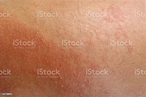 Skin Rash Atopic Eczema Allergy Texture Of Ill Human Skin Stock Photo