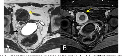 Figure 2 From Parasitic Myoma After Supracervical Laparoscopic