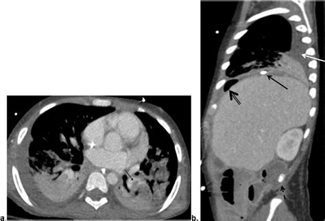 4a Axial Image From Ct Pulmonary Angiogram Shows Filling Defects In