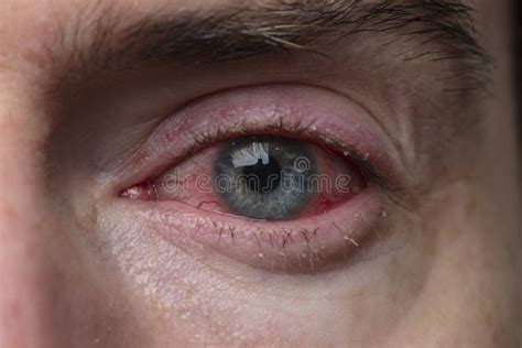 Close Up Of A Severe Bloodshot Eye Blepharitis Conjunctivitis