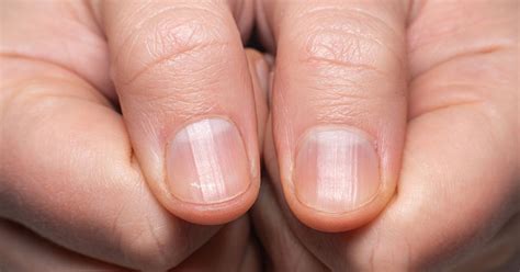 What Ridges In Your Nails Mean And When It S Time To Call A Doctor