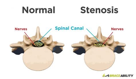 What Is Cervical Spinal Stenosis Of The Neck