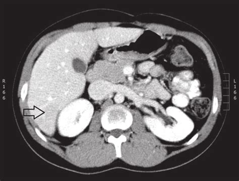Ct Portal Phase Of Contrast Enhancement Subtle Hypodense Lesions In 6