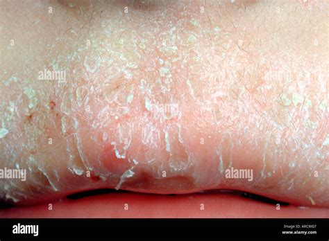 Eczema Stock Photos And Eczema Stock Images Alamy