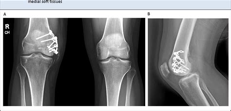 Figure 2 From A Novel Technique For Fixation Of A Medial Femoral