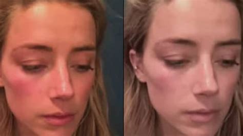 Amber Heard Accused Of Editing Photos That Show Alleged Abuse From