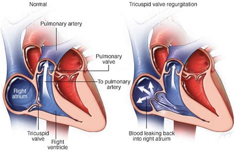 Tricuspid Valve Regurgitation Causes Severity Symptoms Diagnosis Treatment