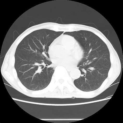 Figure1chest Computed Tomography Ct Obtained During The Patients