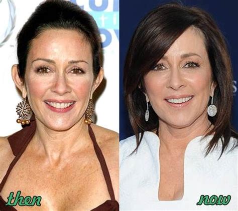 Patricia Heaton Plastic Surgery Before And After Plastic Surgery
