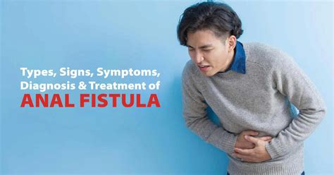 Types Signs Symptoms Diagnosis And Treatment Of Anal Fistula