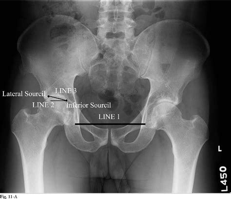 Figure 11 From A Systematic Approach To The Plain Radiographic
