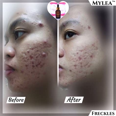 Menyelamatkan kulit dari kerosakan akibat bahaya sinaran uv. Miss DeL: MYLEA FRECKLES SERUM