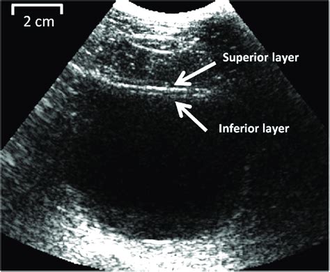Bladder Cavity And Detrusor Layer Inferior Layer As Seen In The