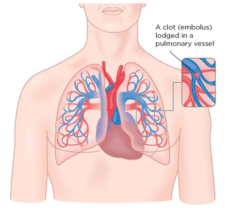 What Is Thrombosis Pulmonary Embolism