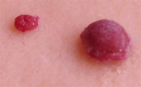 This is especially the case if they are particularly numerous or in a very noticeable area. Cherry Angiomas - Pictures, Symptoms, Causes, Treatment ...