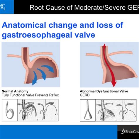 Hiatal Hernia Virginia Heartburn And Hernia Institute