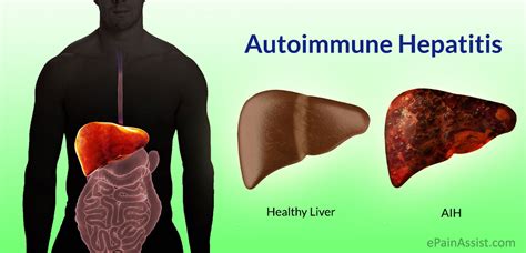 Autoimmune Hepatitisaihcausestypessymptomstreatmentcomplications