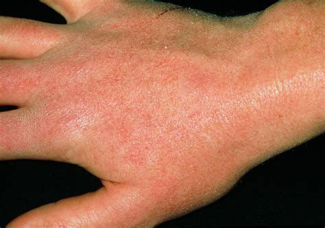 Dry Skin Reaction On Hand Due To Anti Acne Drug Photograph By Dr P Marazziscience Photo Library