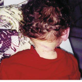 Three nonlethal ligature strangulations filmed by an autoerotic practitioner: Strangulation with scarf (case 4). | Download Scientific ...