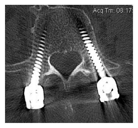 Examples Of Pedicle Screw Placement On Postoperative Ct Imaging A Download Scientific