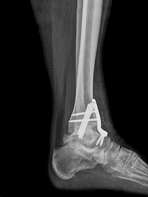 Ankle Fusions Texas Orthopedic And Spine Associates