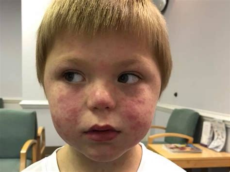 A 5 Year Old Suffered A Full Body Rash From Rocky Mountain Spotted