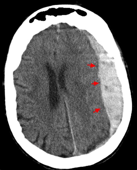 Intracranial Hemorrhage Cause Symptoms Diagnosis Treatment