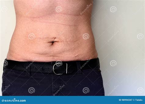 woman belly with stretch marks and scars stock image image of human females 98994347