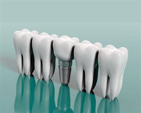 O Que é O Implante Dentário