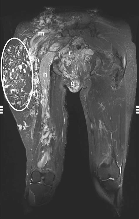 Extensive Venous Malformation In A 39 Year Old Female Patient The