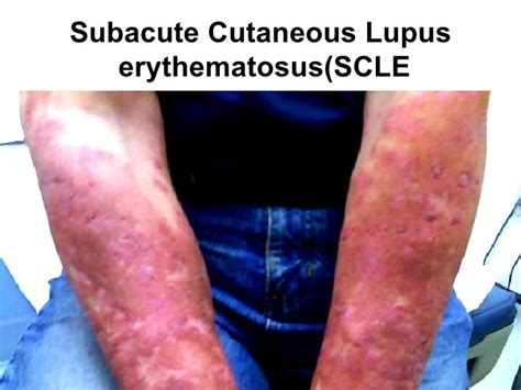 Acute Systemic Lupus Erythematosus