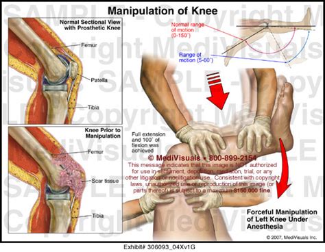 We did not find results for: Manipulation of Knee Medical Illustration