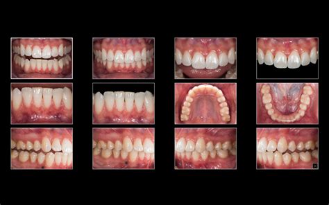 How To Start With Dental Photography