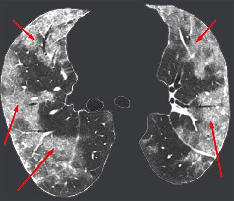 Ground Glass Opacities Interpretation And Management New Health Advisor