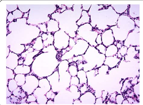 Histology Findings For Lung Tissue Taken From The Centre Right Lobe Of
