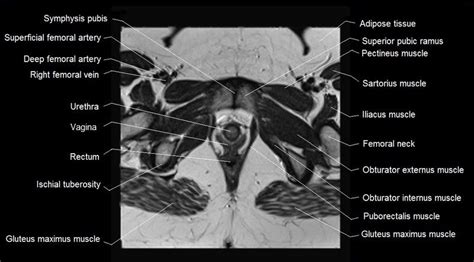 Mri Female Pelvis Anatomy Axial Image Pelvis Anatomy Pelvis Anatomy