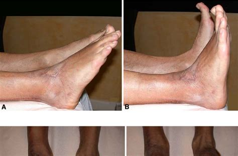 Pdf New Tendon Transfer For Correction Of Drop Foot In Common