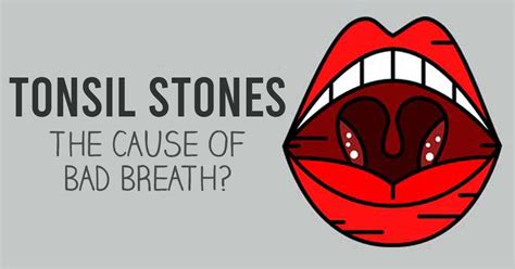 Tonsil Stones The Hidden Source Of Your Bad Breath Williams