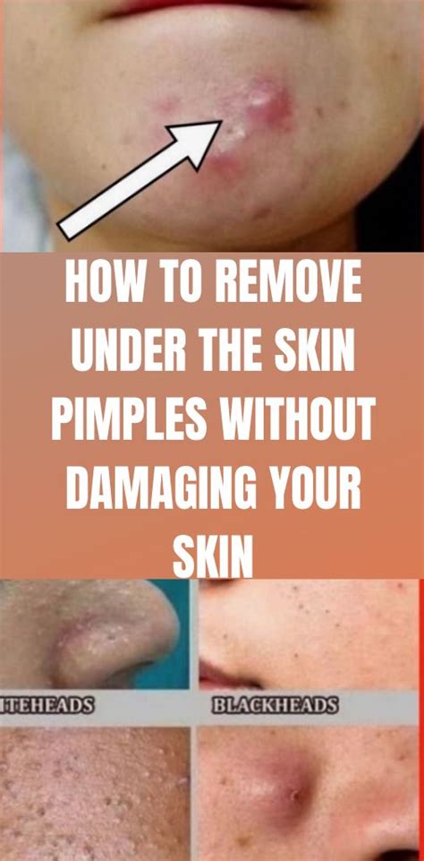 How To Remove Under The Skin Pimples Without Damaging Your Skin