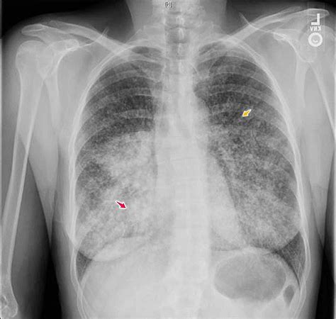 Cureus Adenocarcinoma Of The Lung Presenting With Intrapulmonary