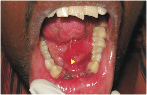 Case 1 Sialolithiasis Of The Left Submandibular Gland 22 Year Old