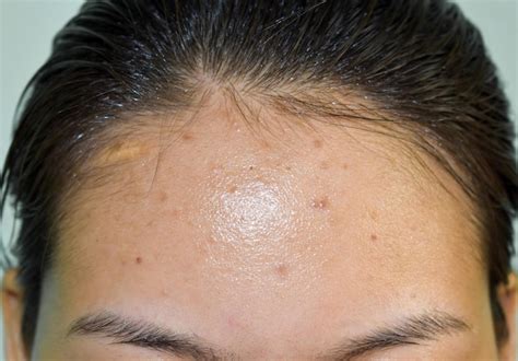 Premium Photo Acne Black Spots And Scars On Forehead