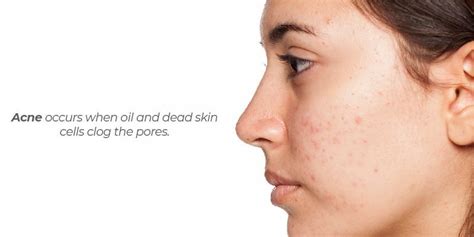 Skin Troubles When To Spot Treat And When To Cover Your Face Delta 5